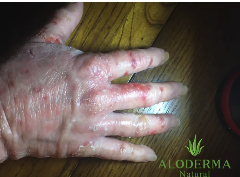 Mão de consumidora antes do uso do gel puro ALODERMA
